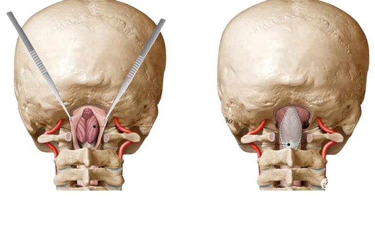 Dị tật Arnold Chiari
